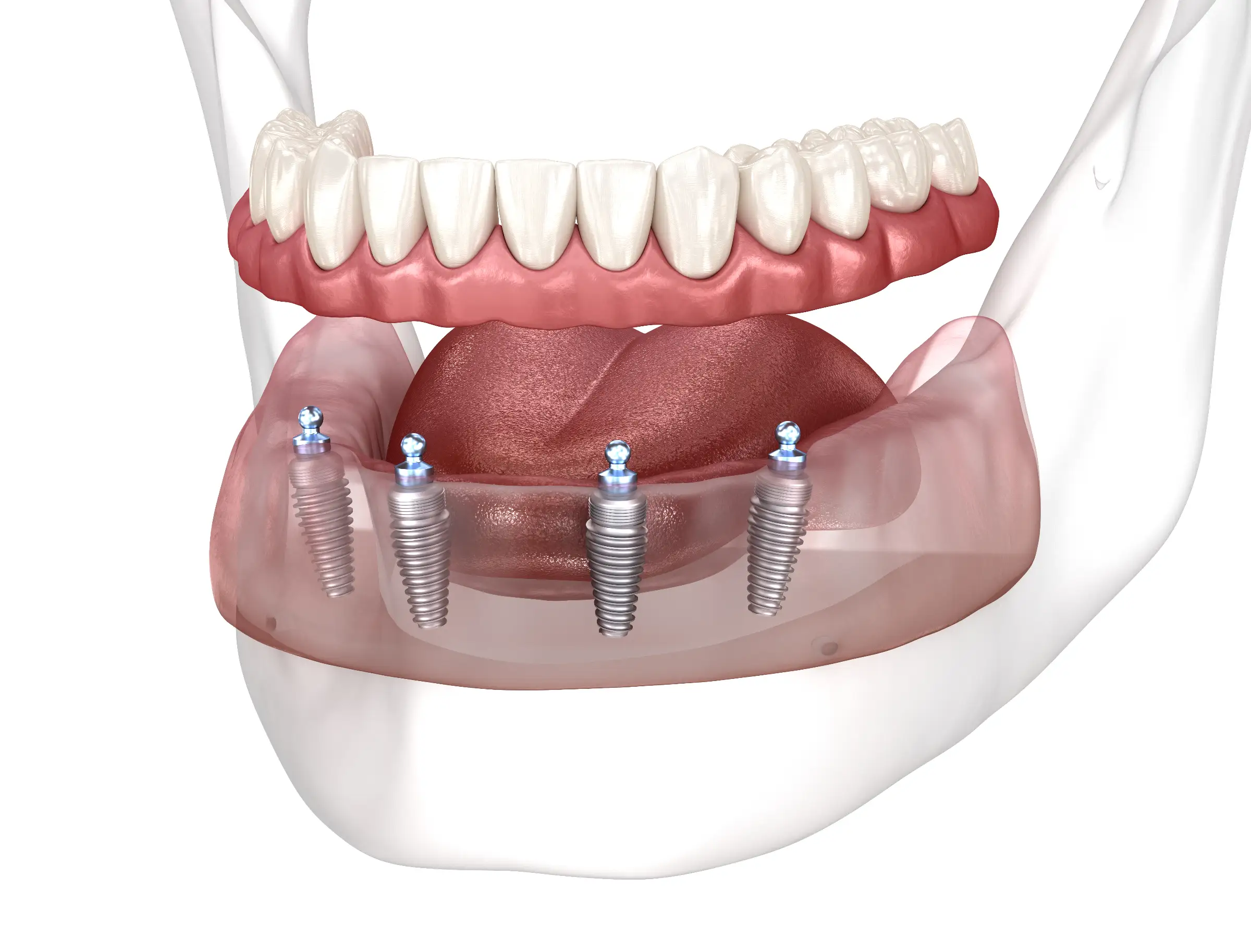Implant Secured Dentures