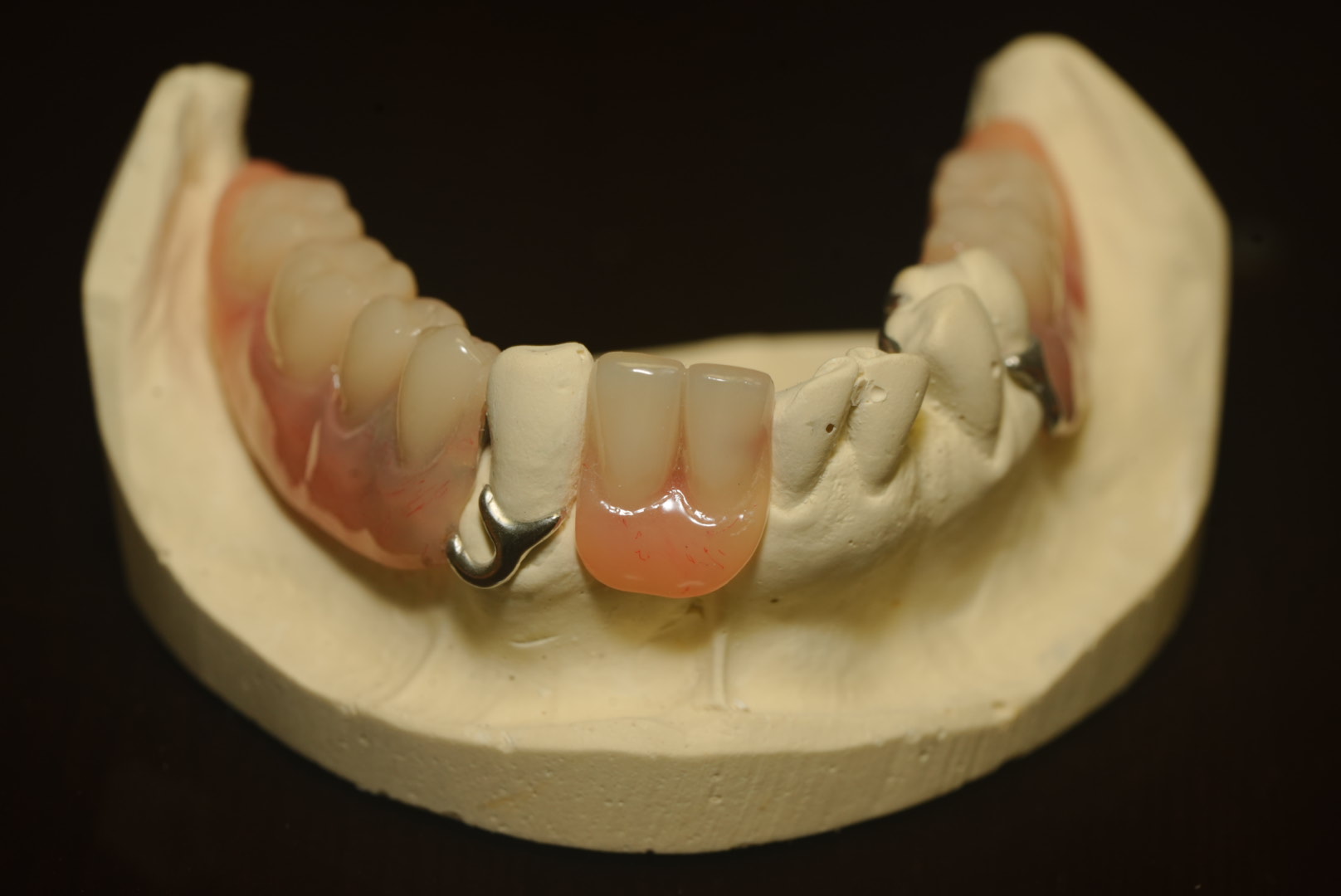Partial Denture