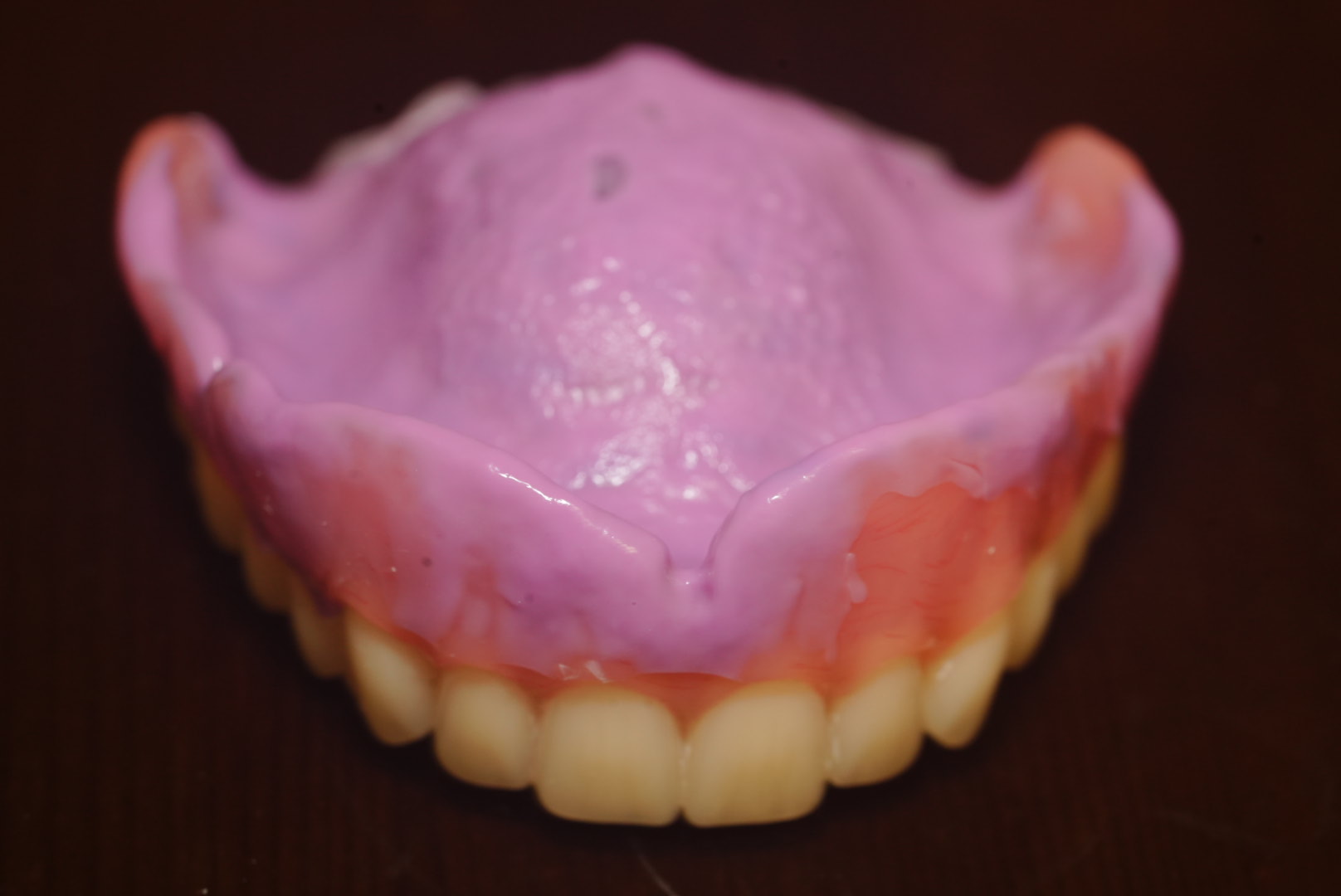 Denture Reline & Rebase